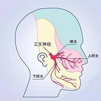 三叉神经痛