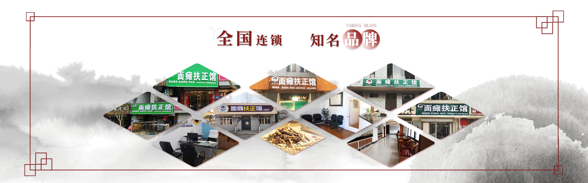 临沂面瘫,临沂吊线风
