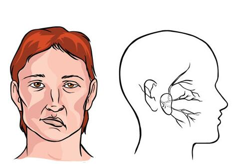 面瘫如何治疗？临沂面瘫老中医谈谈面瘫治疗误区！